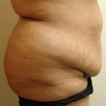 Abdominoplasty before 96421