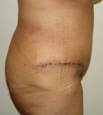 Abdominoplasty after 96421