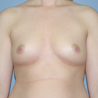 30 year old woman treated with Breast Implants before 3042666