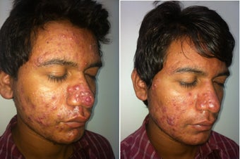 Acne after one month treatment with Accutane 1141285
