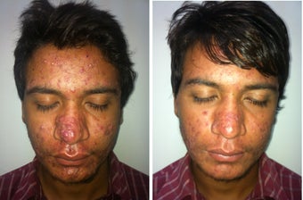 Acne after one month treatment with Accutane before 1141285