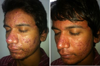 Acne after one month treatment with Accutane after 1141285