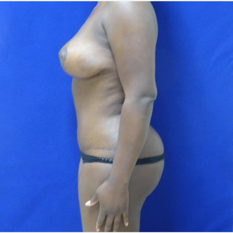 32 y.o. – female – Wise pattern mastopexy with abdominoplasty (mommy makeover) after 3401337