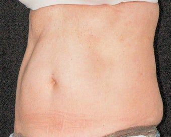 45-55 SculpSure Client after 2 treatments before 3536253