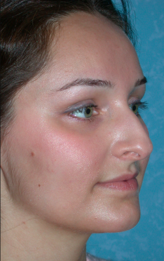 Rhinoplasty results on this 21 year old female before 3732601