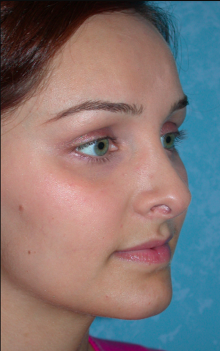 Rhinoplasty results on this 21 year old female after 3732601