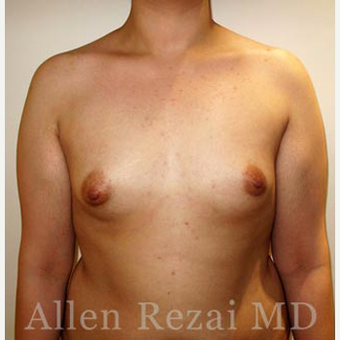Bilateral Breast Augmentation-Patient has type II Tuberous Breast Deformity-Pre- & 20 Months Post-op before 3473927