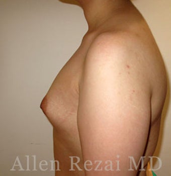 Bilateral Breast Augmentation-Patient has type II Tuberous Breast Deformity-Pre- & 20 Months Post-op 3473927