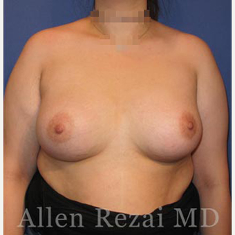 Bilateral Breast Augmentation-Patient has type II Tuberous Breast Deformity-Pre- & 20 Months Post-op after 3473927