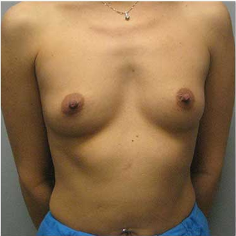 38 year old woman treated with Ideal Implant before 3468833