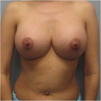 38 year old woman treated with Ideal Implant after 3468833