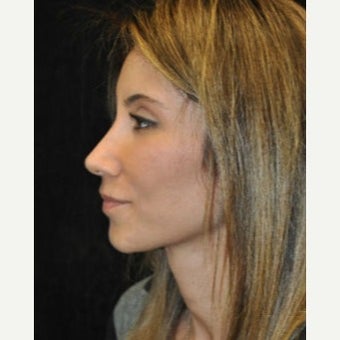 Fat Transfer after 1638321