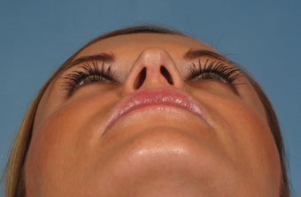 31 year old female with wide boxy tip who was treated with rhinoplasty 1194043