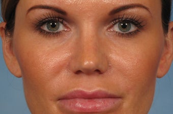 31 year old female with wide boxy tip who was treated with rhinoplasty after 1194043