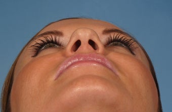 31 year old female with wide boxy tip who was treated with rhinoplasty 1194043