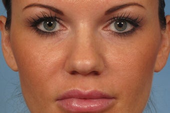 31 year old female with wide boxy tip who was treated with rhinoplasty before 1194043