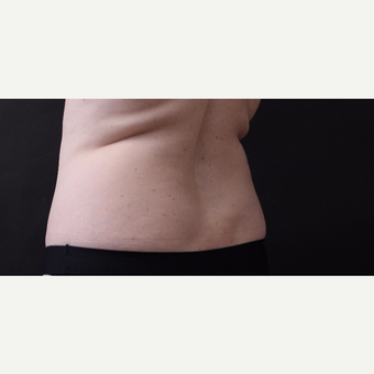 46 year old woman treated with CoolSculpting before 3168893