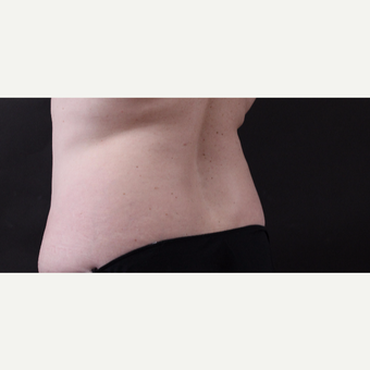 46 year old woman treated with CoolSculpting after 3168893