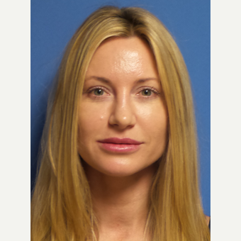33 year old woman treated with Rhinoplasty and septoplasty after 3326226