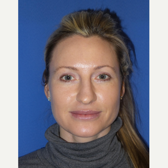 33 year old woman treated with Rhinoplasty and septoplasty before 3326226
