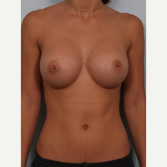 18-24 year old woman treated with Breast Implants after 3502606