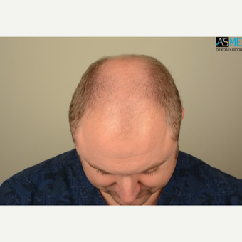 35-44 year old man treated with FUE Hair Transplant before 3053533