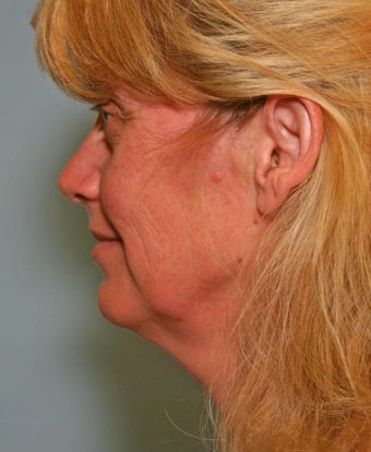 49 y/o MACS Lift & Lower Blepharoplasty with return to work in 12 days before 928129
