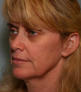 49 y/o MACS Lift & Lower Blepharoplasty with return to work in 12 days 928129