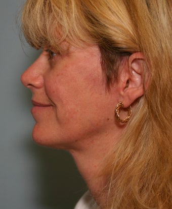 49 y/o MACS Lift & Lower Blepharoplasty with return to work in 12 days after 928129