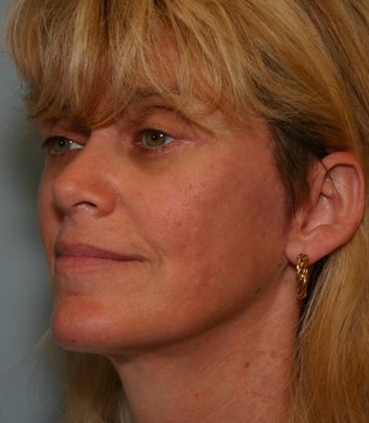 49 y/o MACS Lift & Lower Blepharoplasty with return to work in 12 days 928129