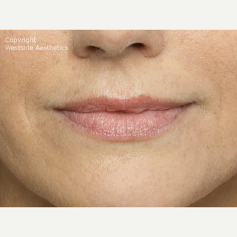 Belotero for Lines Around Mouth after 2988994