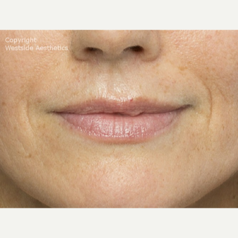 Belotero for Lines Around Mouth before 2988994