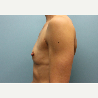 45-54 year old woman treated with Fat Transfer before 3748280