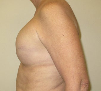 Breast Reconstruction 735303