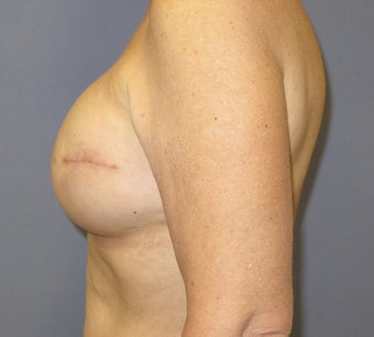 Breast Reconstruction 735303