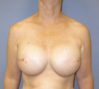 Breast Reconstruction after 735303