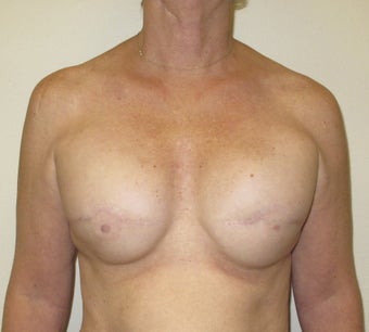 Breast Reconstruction before 735303