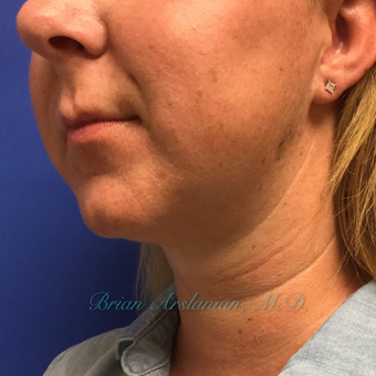 35-44 year old woman treated with Kybella treatment for double chin after 3151942