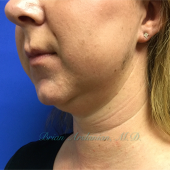 35-44 year old woman treated with Kybella treatment for double chin before 3151942