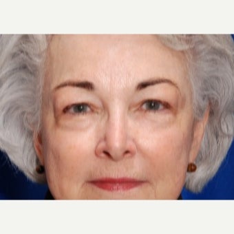 65-74 year old woman treated with Eyelid Surgery before 2149356