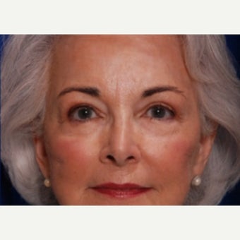 65-74 year old woman treated with Eyelid Surgery after 2149356