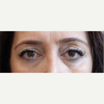 Minimum invasive Brow Lift and Upper Blepharoplasty before 2091849