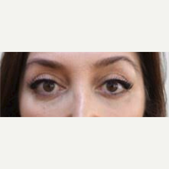 Minimum invasive Brow Lift and Upper Blepharoplasty after 2091849