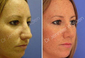 Septorhinoplasty before 1112642