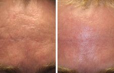 Before and after Acne Scar Removal with Laser before 1094077
