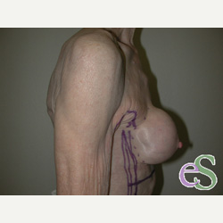 Breast Implant Revision before 3373457