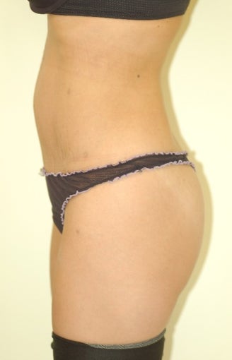 35-44 year old woman treated with Mini Tummy Tuck 1566404