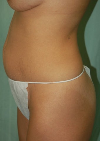 35-44 year old woman treated with Mini Tummy Tuck 1566404