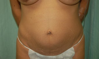 35-44 year old woman treated with Mini Tummy Tuck before 1566404