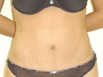 35-44 year old woman treated with Mini Tummy Tuck after 1566404